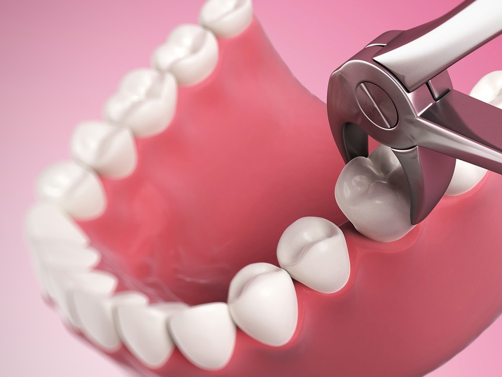 Экстракция поврежденных зубов - Когда стоит удалить зуб